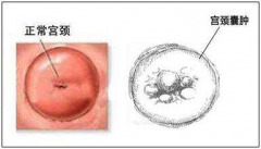 女性怎么会得宫颈囊肿呢？